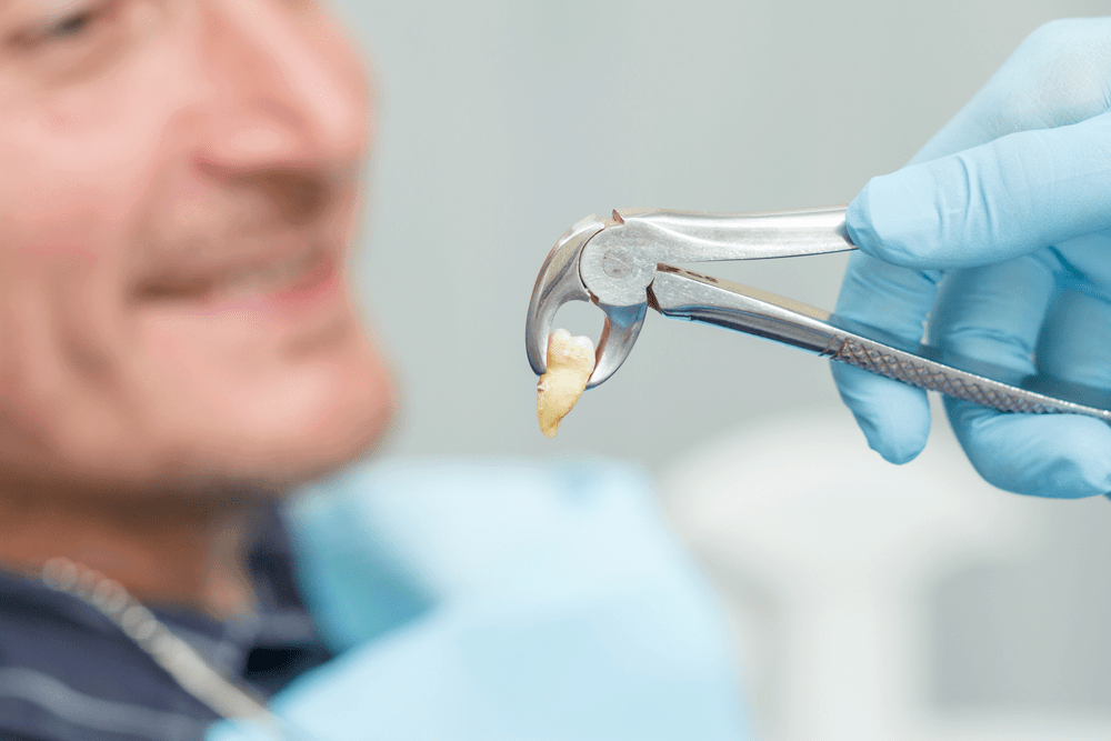 painless tooth extraction